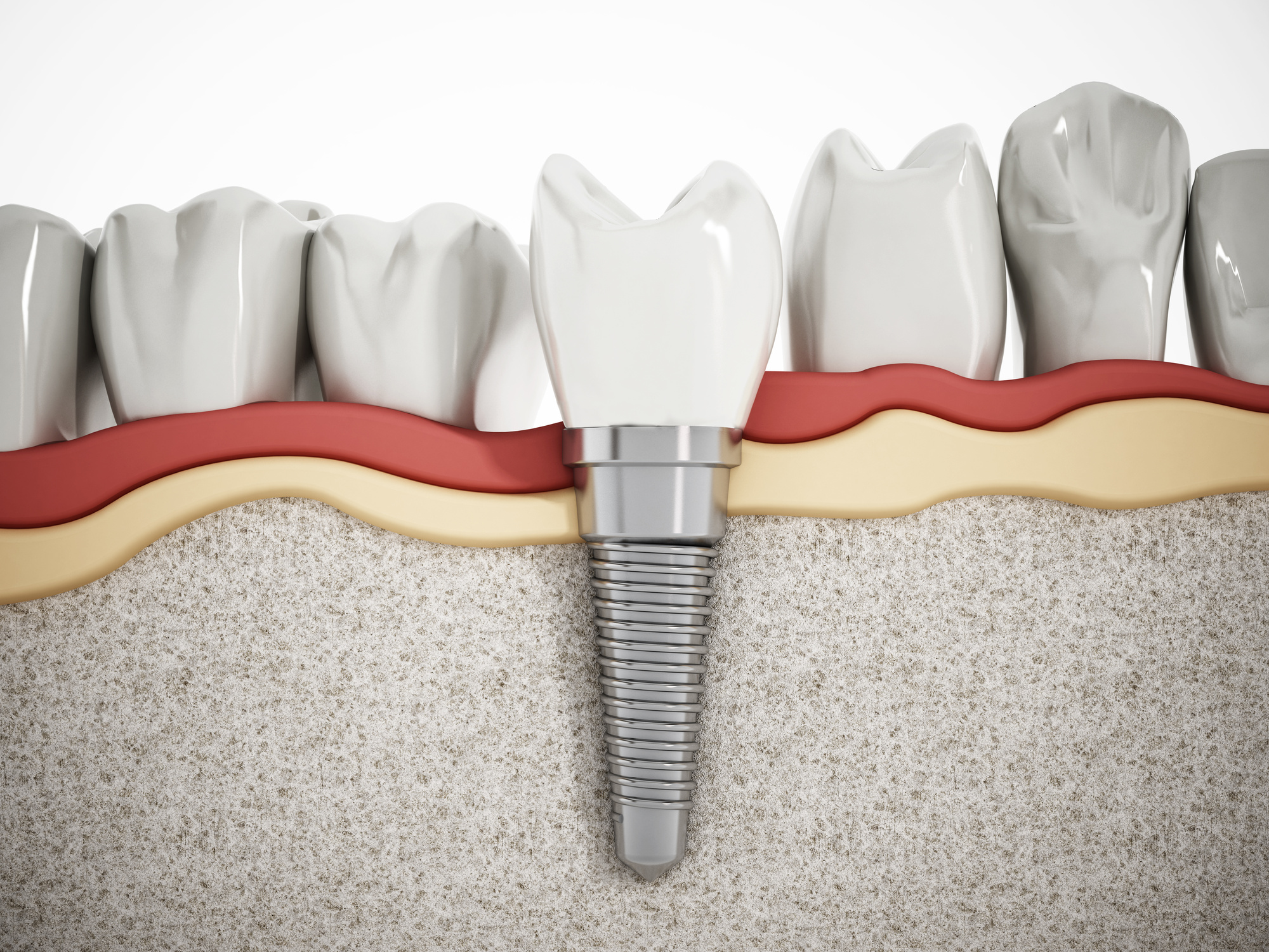 Dental Implants: How Worried Should You Be About Pain?