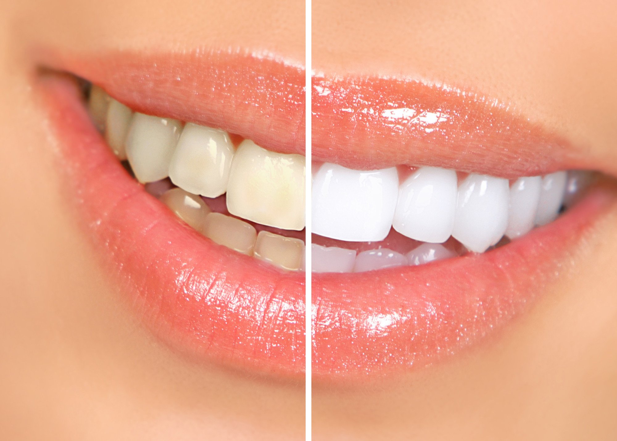 Reclaim Your Smile: How to Win the Battle Against Teeth Stains